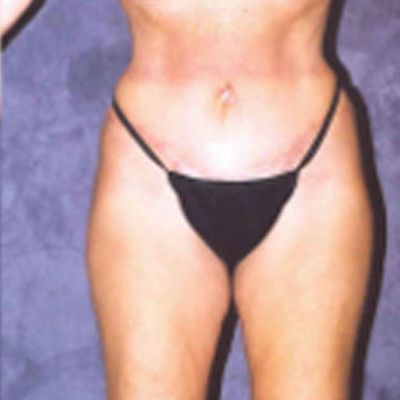 Abdominoplasty Before & After