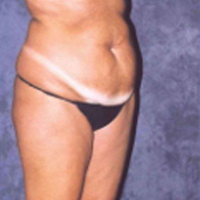 Abdominoplasty Before & After