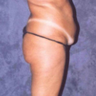 Abdominoplasty Before & After