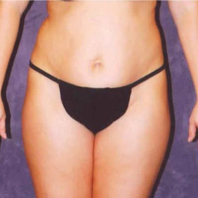 Abdominoplasty Before & After