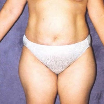Abdominoplasty Before & After