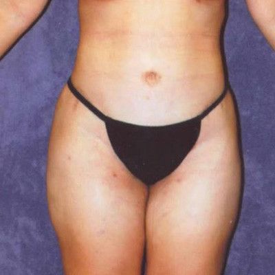 Abdominoplasty Before & After
