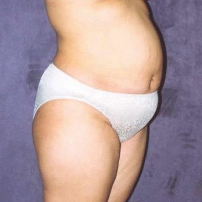 Abdominoplasty Before & After