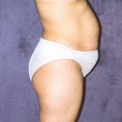 Abdominoplasty Before & After