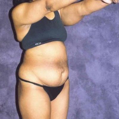 Abdominoplasty Before & After