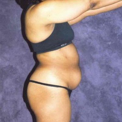 Abdominoplasty Before & After