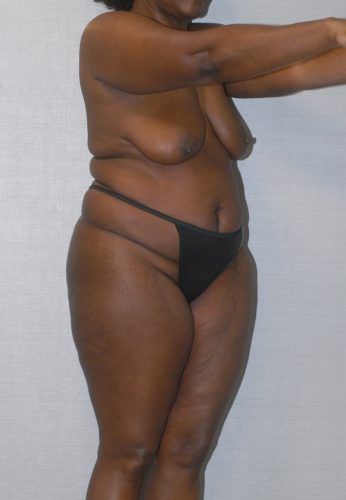 Abdominoplasty Before & After