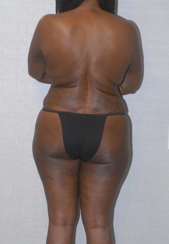 Abdominoplasty Before & After