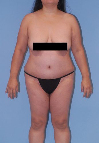 Abdominoplasty Before & After