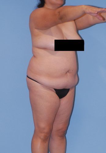 Abdominoplasty Before & After
