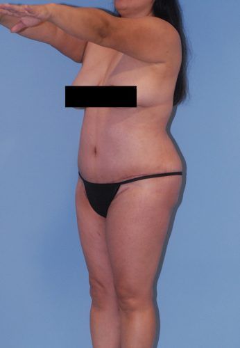Abdominoplasty Before & After