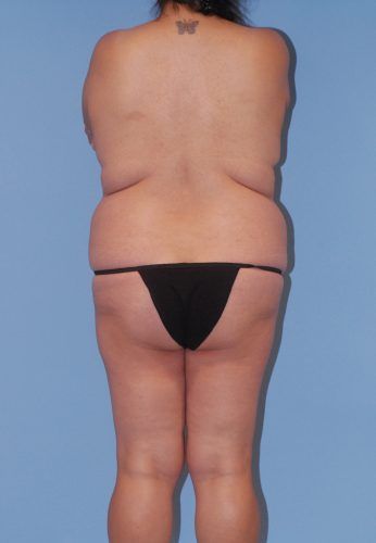 Abdominoplasty Before & After