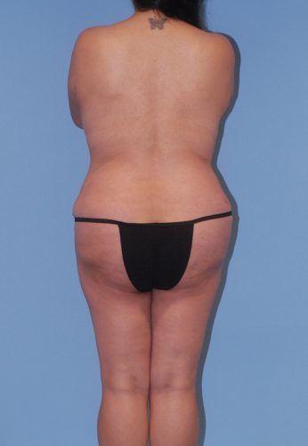 Abdominoplasty Before & After