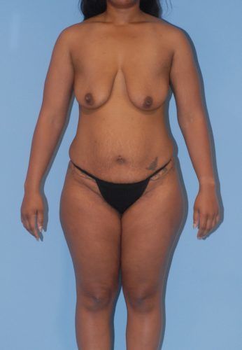 Abdominoplasty Before & After