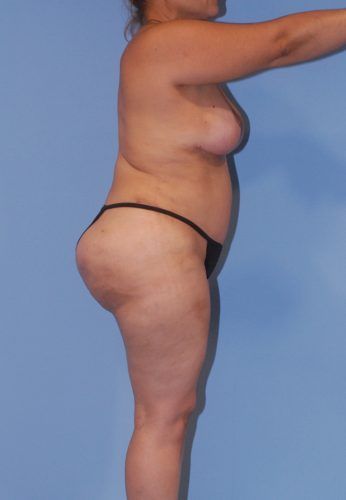 Abdominoplasty Before & After