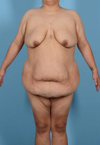 Abdominoplasty Before & After