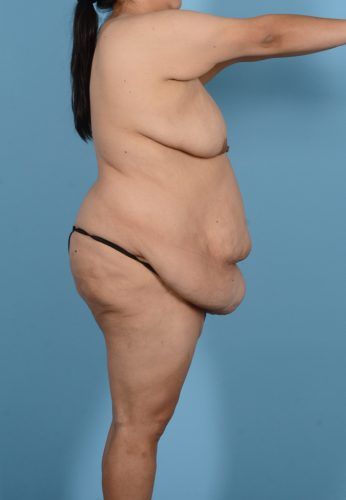 Abdominoplasty Before & After