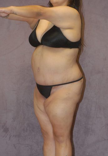 Abdominoplasty Before & After