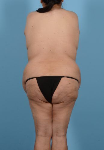 Abdominoplasty Before & After