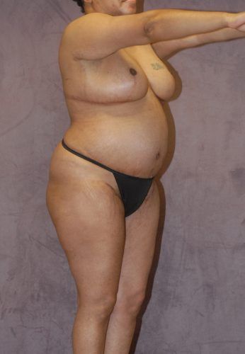 Abdominoplasty Before & After