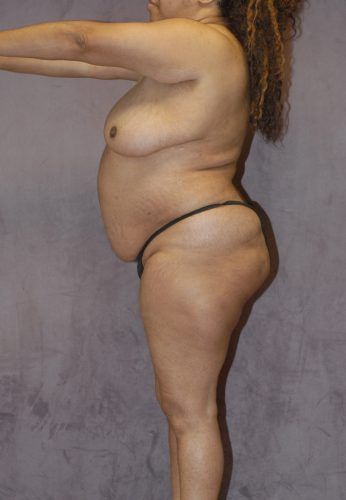 Abdominoplasty Before & After