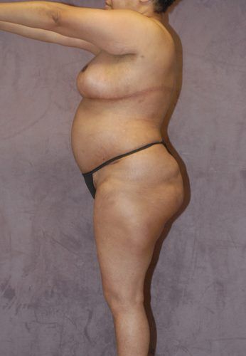 Abdominoplasty Before & After