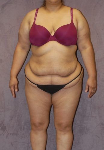 Abdominoplasty Before & After