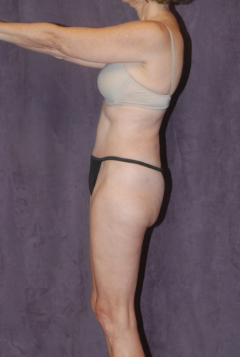 Abdominoplasty Before & After