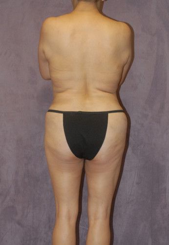 Abdominoplasty Before & After