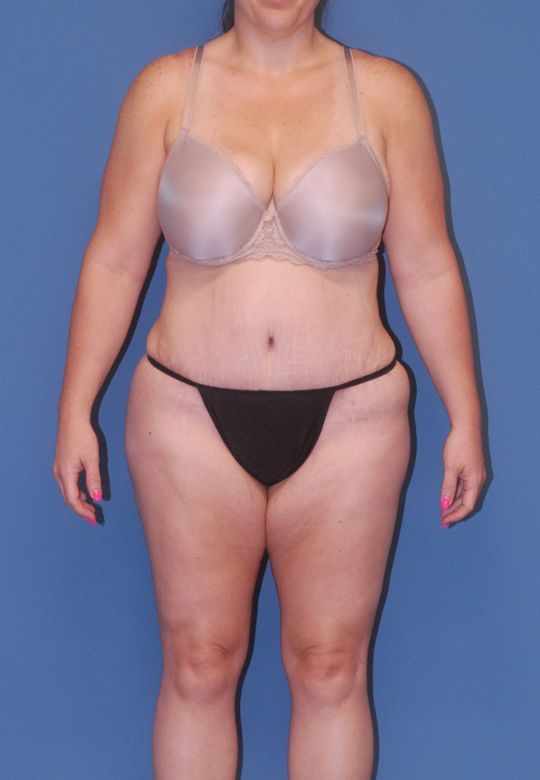 Abdominoplasty Before & After