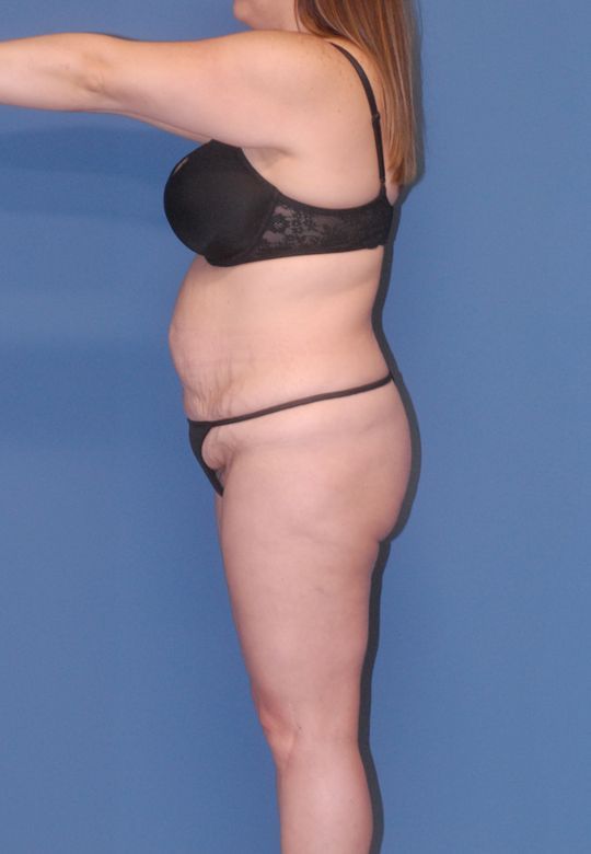 Abdominoplasty Before & After