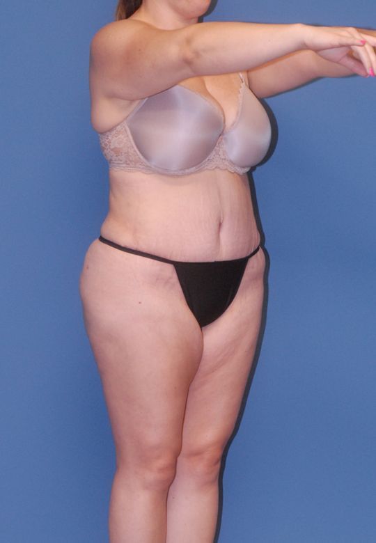 Abdominoplasty Before & After