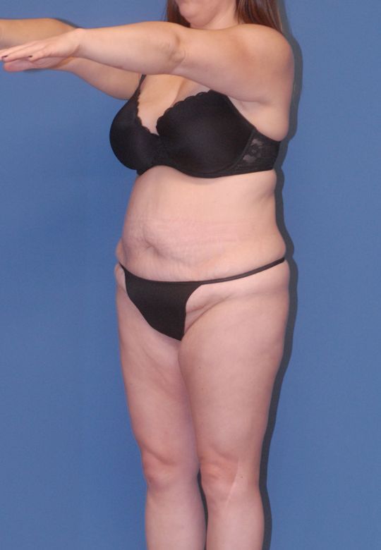 Abdominoplasty Before & After