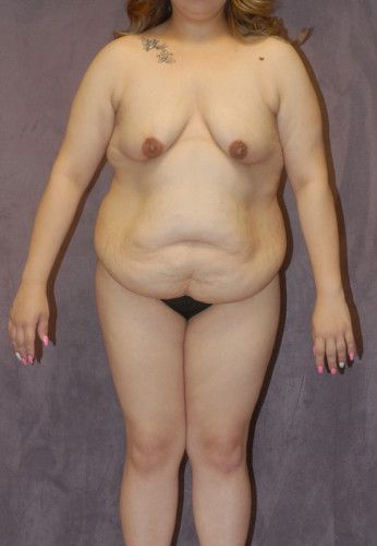 Abdominoplasty Before & After