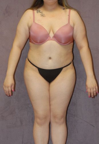 Abdominoplasty Before & After
