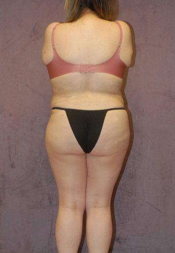 Abdominoplasty Before & After