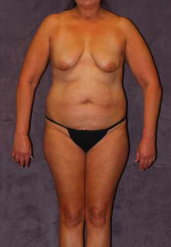 Abdominoplasty Before & After