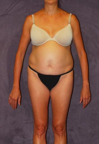 Abdominoplasty Before & After