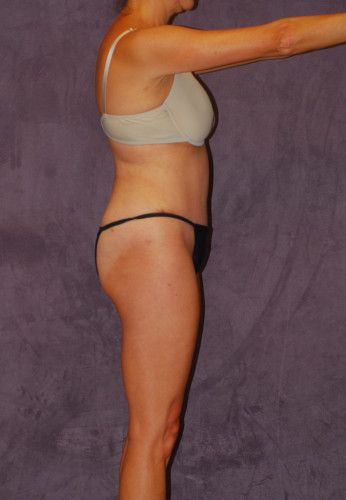 Abdominoplasty Before & After