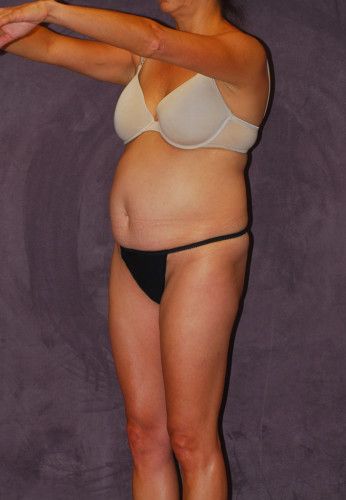 Abdominoplasty Before & After