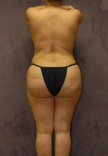 Abdominoplasty Before & After