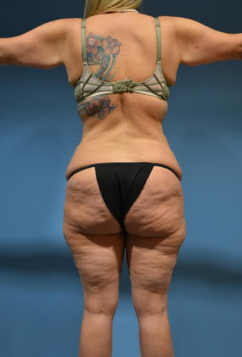 Abdominoplasty Before & After