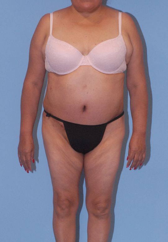 Abdominoplasty Before & After