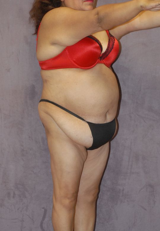 Abdominoplasty Before & After