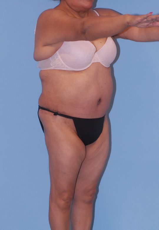 Abdominoplasty Before & After