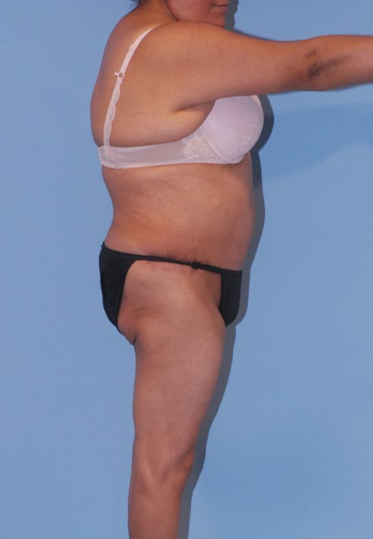 Abdominoplasty Before & After