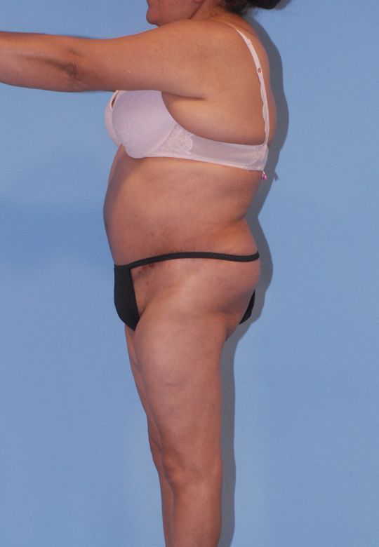 Abdominoplasty Before & After