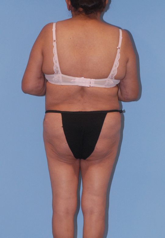 Abdominoplasty Before & After