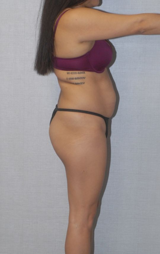 Abdominoplasty Before & After