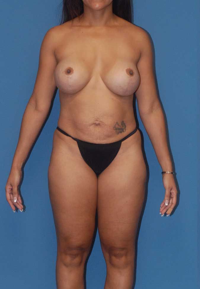 Abdominoplasty Before & After